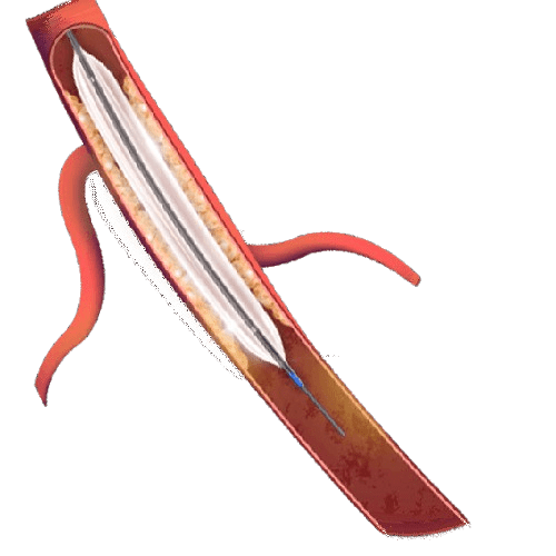 Tresfort™ 18 PTA Balloon Catheter