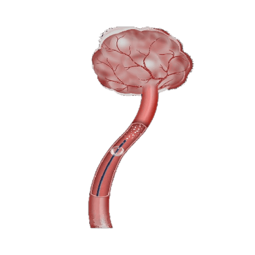Distailâ„¢ Bonbon Balloon Occlusion Microcatheter