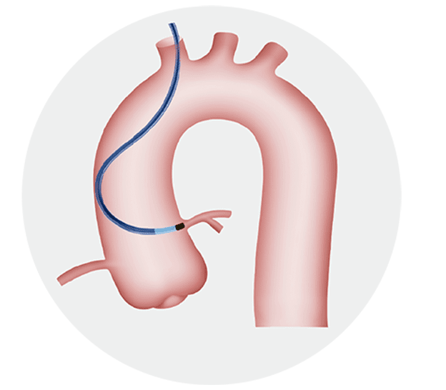 March™ Guiding Catheter
